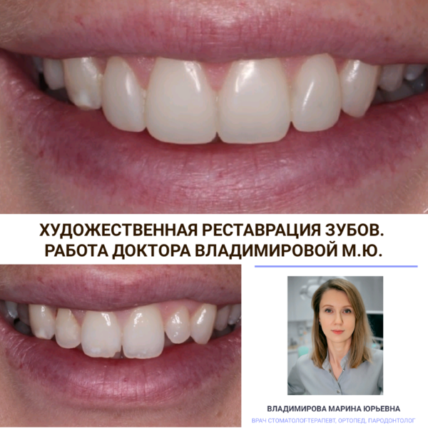 Художественная реставрация зубов: методы восстановления и особенности материалов