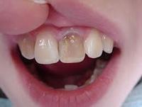 Отбеливание зубов в домашних условиях: самый лучший способ отбеливания без вреда