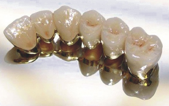 Технология протезирования зубов металлокерамикой Имплантация зубов «под ключ» Томск Обручева
